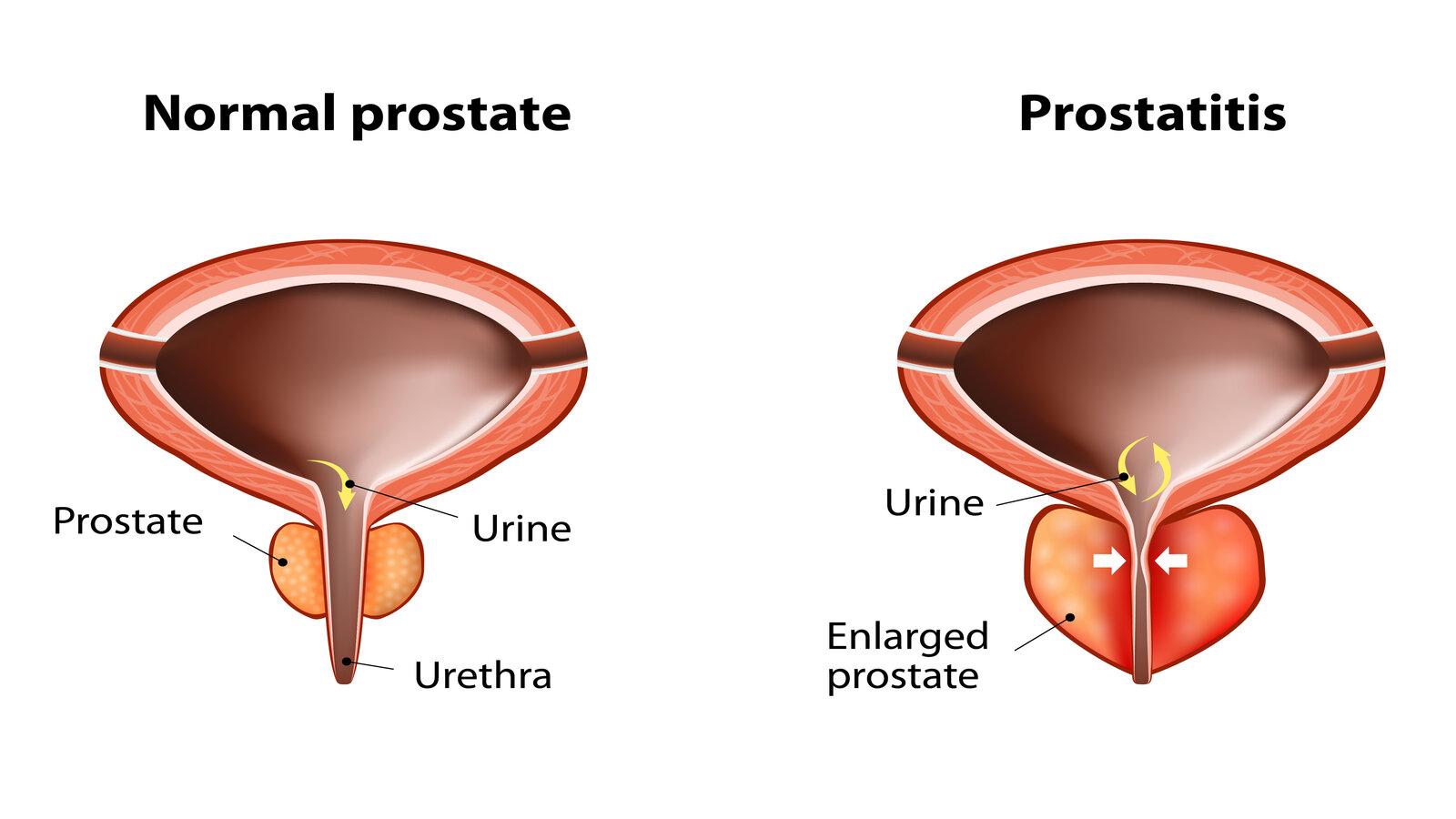 Benign Prostatic Hyperplasia (BPH)